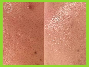 ヴィオール 名古屋栄店(VIOR)/1回でも毛穴が変わる♪