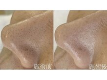 ビビ(VIVI)/毛穴の黒ずみに