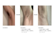 ベル(belle)/脇脱毛経過！