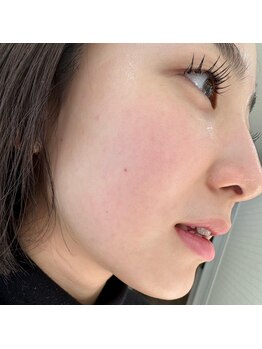 プリューム(Plume)/プラズマフェイシャル