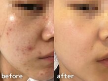 サージュクロレ 松戸店(sage colorer)/クリスタルハーブピーリング