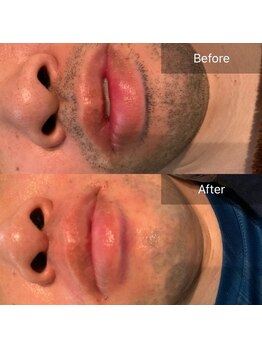 トータルエステサロン ポイント(POINT)/メンズ脱毛