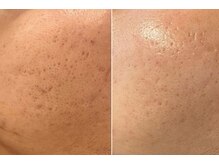 ラエッセ 恵比寿(LAESSE)/毛穴・美白専門店 LAESSE 恵比寿