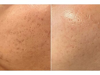 ラエッセ 恵比寿(LAESSE)/毛穴・美白専門店 LAESSE 恵比寿