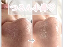 シャイニー(SHINY)の雰囲気（ハイドラ毛穴洗浄は幅広い年代に大人気☆つるんと仕上がりに）