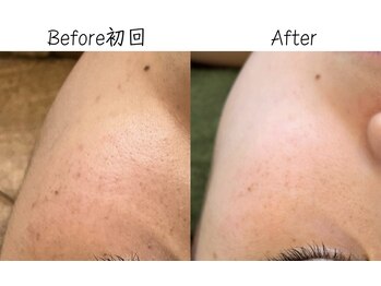 エリア(area.)/4、【シミケア15分】