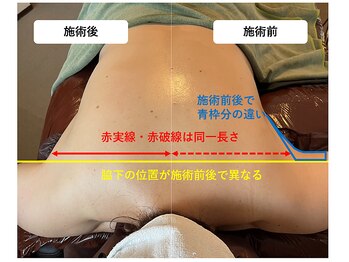 スパークリングセルフ(Sparkling Self)/二の腕・背中ライン　施術前後