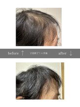 青空 天神大名店(SORA)/マイクロチップ頭皮 &nbsp;2回