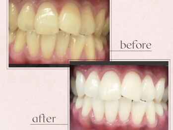 ルアナシンフォニア エクシア 池袋店(Luana-Sinfonia)/ホワイトニングビフォーアフター