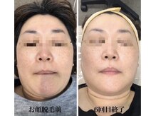 ホッコリ 府中店(HOKKORI)/女性人気！顔脱毛で化粧ノリup！