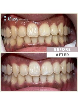 イージーホワイトニング 神戸三宮店(easy whitening)/お客様の症例写真です★