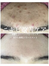 リリアーナ(LILIANA)/ハーブピーリングでニキビケア
