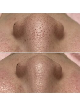 アイブロウサロン アヴィ(A‘VI)/小鼻毛穴洗浄