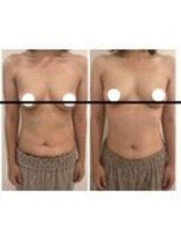 美人バスト 表参道店/【バストアップ/育乳 症例】☆