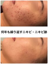 ビオプラス(BioPlus+) 繰り返す ニキビケア