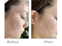 ロア(Roa)の雰囲気（ニキビ肌改善◎専門スタッフ◎効果絶大ストレスフリーの毎日へ）