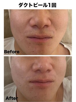 マーレン(Malen)/ダクトピール症例写真