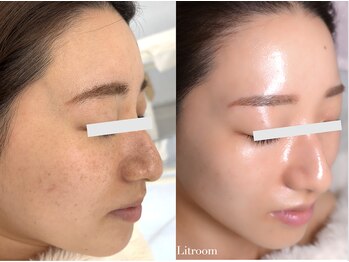 リトルーム(Litroom: from Seoul)/毛穴もくすみもここまで変わる。