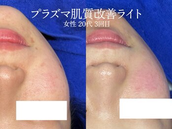 エイトスキン(8skin)/プラズマ肌質改善(毛穴洗浄付)