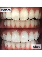 LBSホワイトニング 上野店/お客様のビフォーアフター