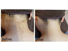 コハサロン(COHA SALON)/脱毛効果！美肌、美白も！