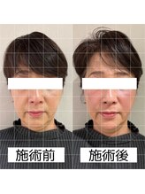 ヴィーライン 大阪梅田院(VeLine)/鍼灸／美容鍼／小顔／大阪／梅田