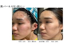 キラベル 平塚店(KiraBelle)/光フェイシャル