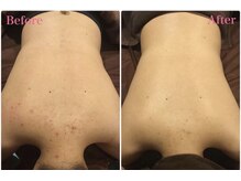 エヌエースキン 川崎店(NAskin)の雰囲気（お背中のシミ、ニキビケアも/ハーブピーリング/ニキビケア/川崎）