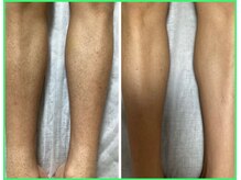 クリア 尾張旭店(Clear)/【Clear脱毛ビフォーアフター」