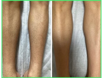 クリア 尾張旭店(Clear)/【Clear脱毛ビフォーアフター」