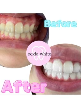 エクシアホワイトニング 中野駅北口店/ホワイトニングビフォーアフター