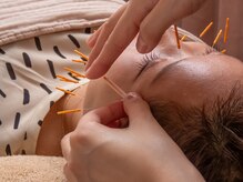 フィーカ/美容鍼