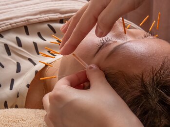 フィーカ/美容鍼