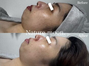 ナチュールムーン(Nature moon.)/ハーブピーリング