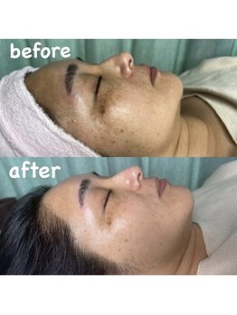 ブルーム(bloom)/ハーブピーリング/ララピール