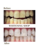 ホワイトニングショップ 安城店/【BeforeAfter】