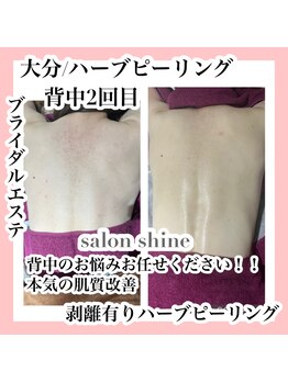 サロンシャイン(Salon Shine)/本気の肌質改善