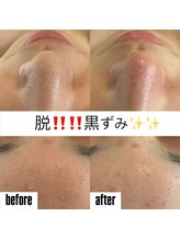 ブルーシー(BLUESEA)/毛穴洗浄