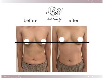 ベルビューティー(belle beauty)/バストアップ◇症例◇