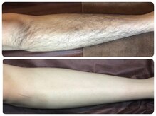 脱毛サロン ベル(Bell)/しっかり効果！ツルツルお肌◎