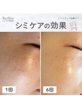 リスキン(Re:Skin)/