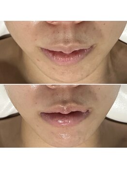 レアリゼ(Realiser)/人中短縮マッサージ