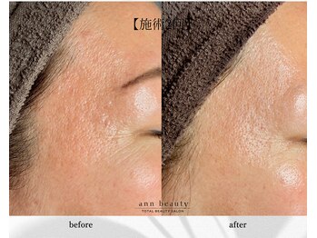 アン ビューティー(ann beauty)/施術2回【症例写真】40代