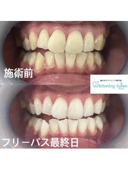ホワイトニングサロン 熊本店/熊本セルフホワイトニング