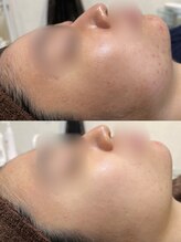 アンジェロ/【ニキビケア】肌育プログラム