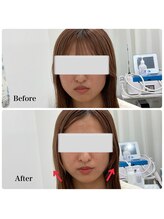 モスト(MOST)/フェイシャル高周波