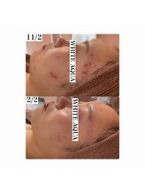 ホワイトアクア 加古川店(WHITE AQUA)/ハーブピーリングで肌荒れ改善