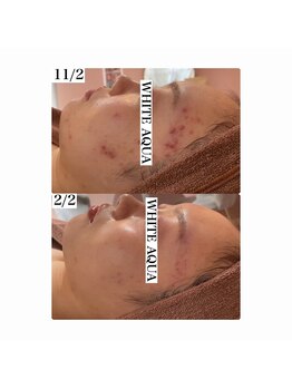 ホワイトアクア 加古川店(WHITE AQUA)/ハーブピーリングで肌荒れ改善