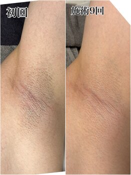 ルシャトン(Le Chaton)/ワキ脱毛