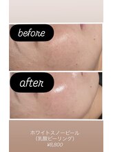 エードット(A.)/ホワイトスノーピール